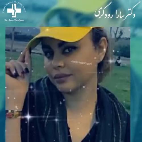 جراحی-بینی-18