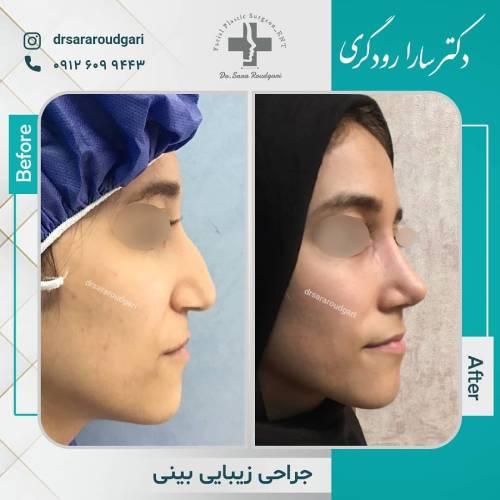 جراحی-بینی-21