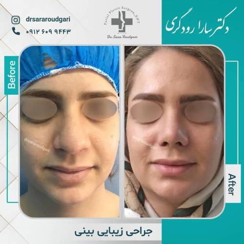 جراحی-بینی-30