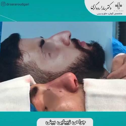 جراحی-بینی-33