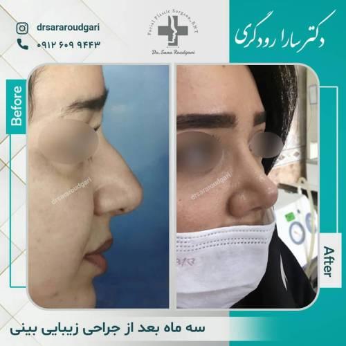جراحی-بینی-39