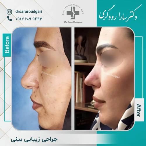 جراحی-بینی-42
