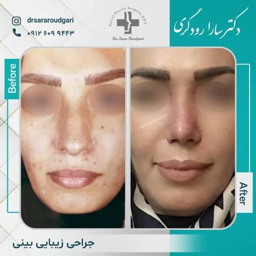 جراحی-بینی-43