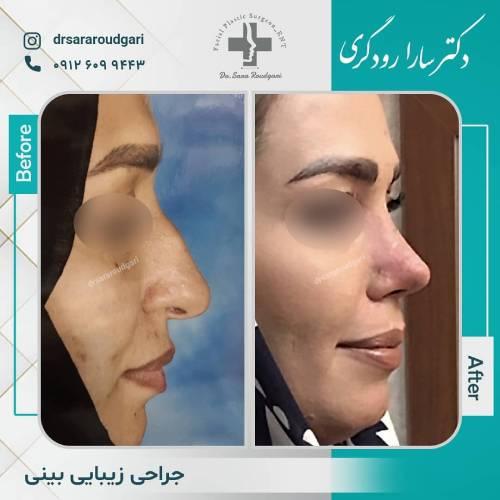 جراحی-بینی-44