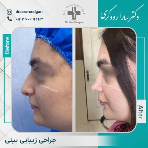 جراحی-بینی-71