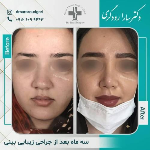 جراحی-بینی37